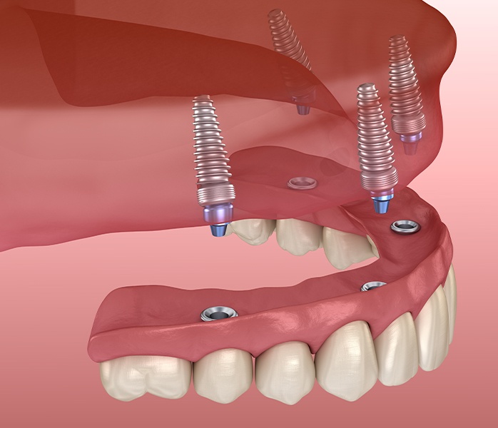 Animated smile during all on four denture placement