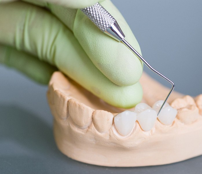 A close-up of a dental bridge in Millersville