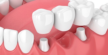 A 3D illustration of a traditional dental bridge in Millersville