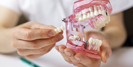  A dentist showing an implant dental bridge in Millersville
