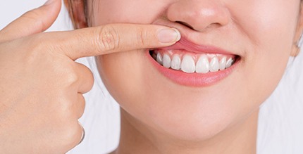 Woman showing off her gums