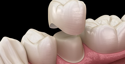 A 3D illustration of a dental crown being placed