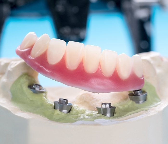 Model smile dental implant retained denture