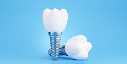illustration of dental implants 