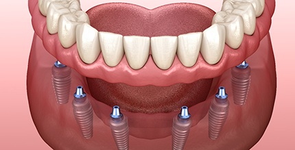 implant dentures in Millersville