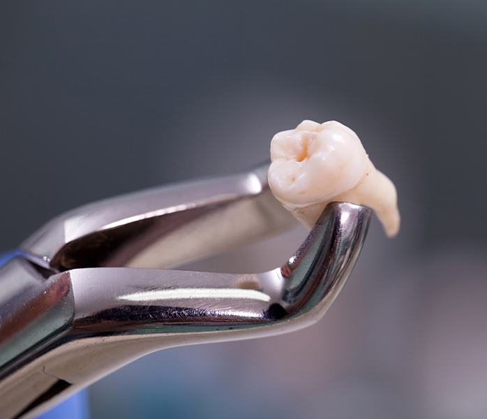 Metal clasp holding an extracted tooth