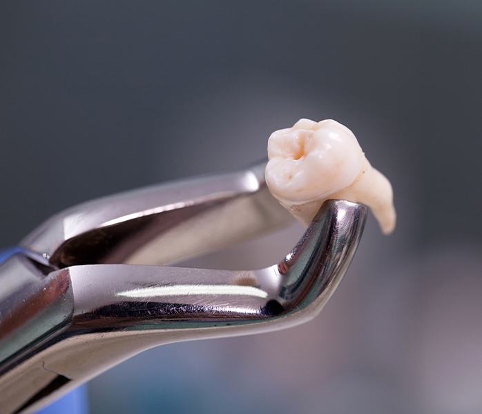 Metal clasp holding an extracted tooth