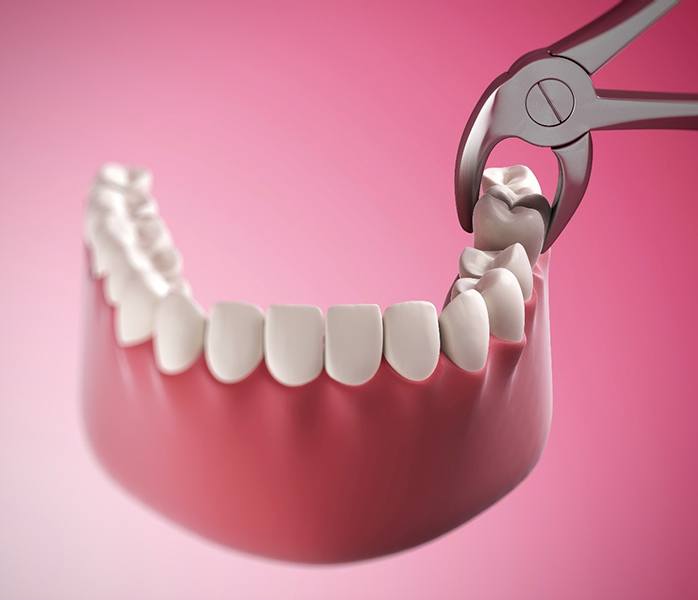 diagram of tooth extraction in Millersville