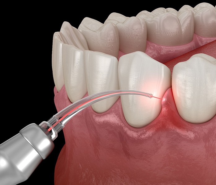 Illustration of laser tissue gum recontouring with black background