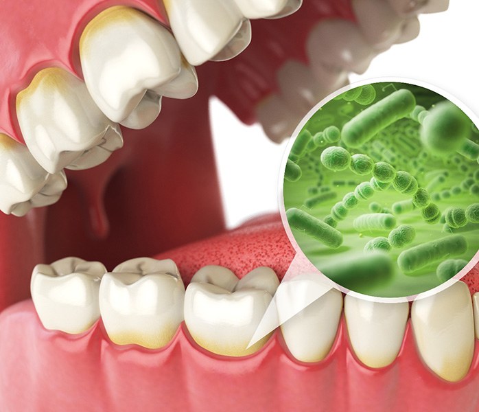 Illustration of germs permeating gumline