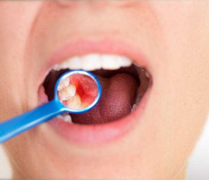 Someone’s red gums reflected in blue dental mirror
