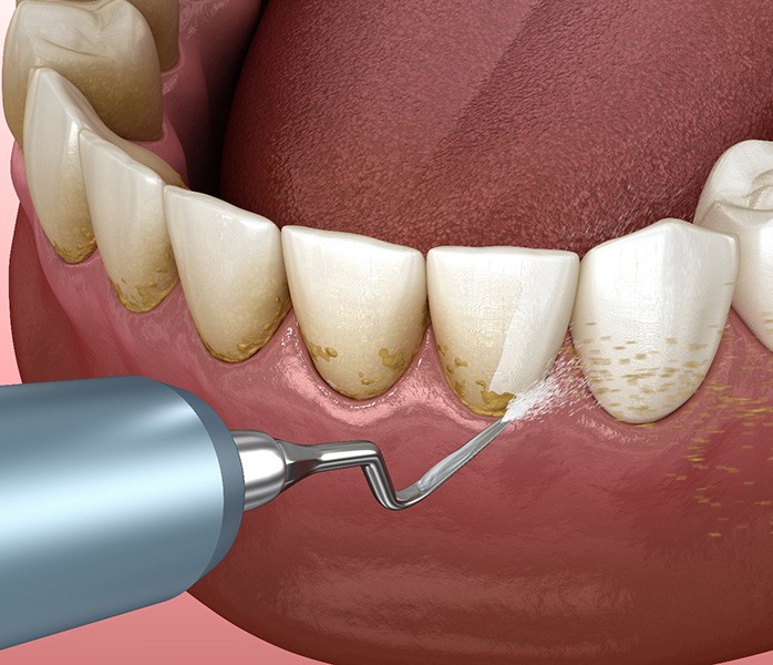 Illustration showing dental instrument cleaning plaque off gums in lower arch