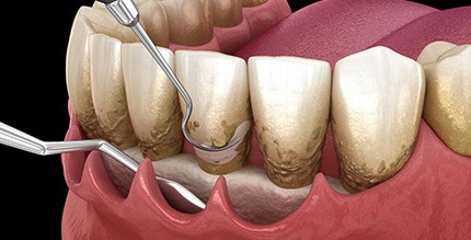 Illustration depicting scaling and root planing with black background