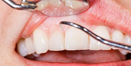 Closeup of someone’s gums being examined