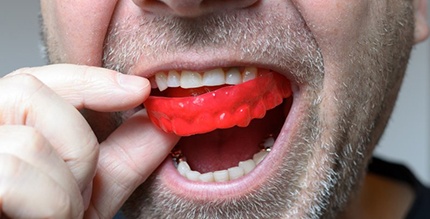 a man wearing a mouthguard to protect his smile