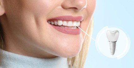 woman smiling with dental implant in mouth 