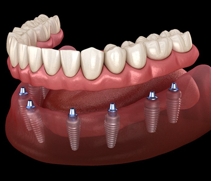 Illustration of implant denture being attached to dental implants