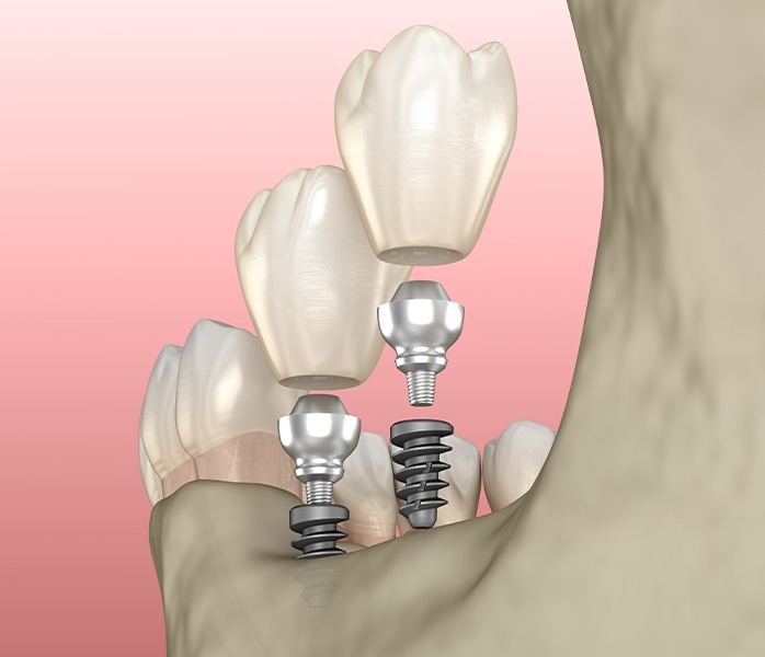 Dental Implant Placement Oral Surgery Transcendent Smiles