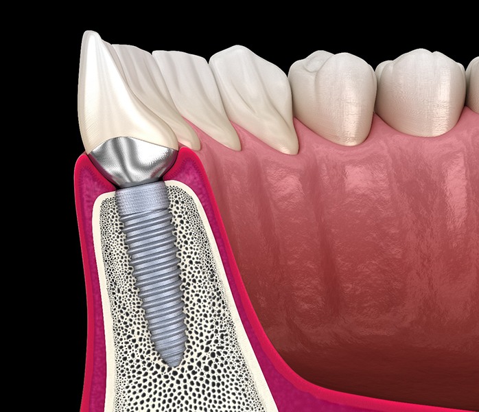 Diagram of an integrated dental implant in Millersville