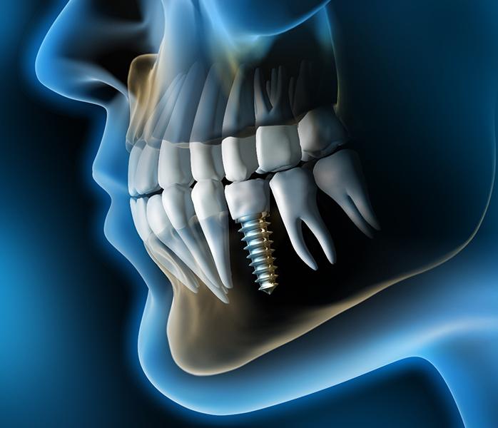 Diagram of an integrated dental implant in Millersville