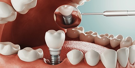Diagram highlighting procedure for dental implants in Millersville