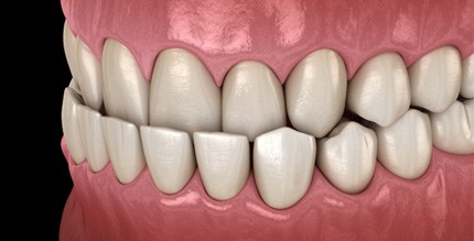 Illustration of underbite