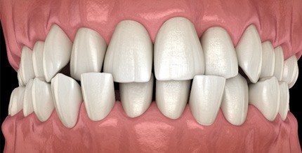 Illustration of crossbite