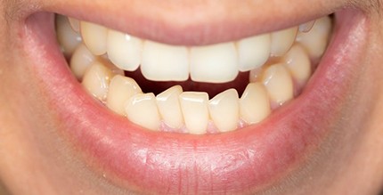 Closeup of patient with crowded teeth in Millersville before Invisalign 