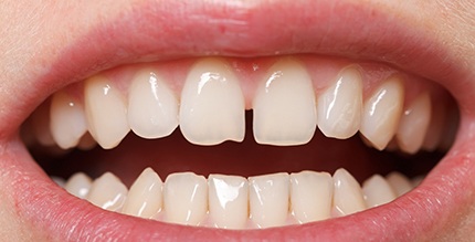 Closeup of patient with gap between front teeth in Millersville before Invisalign 
