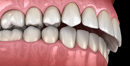 Digital illustration of overbite in Millersville before Invisalign 