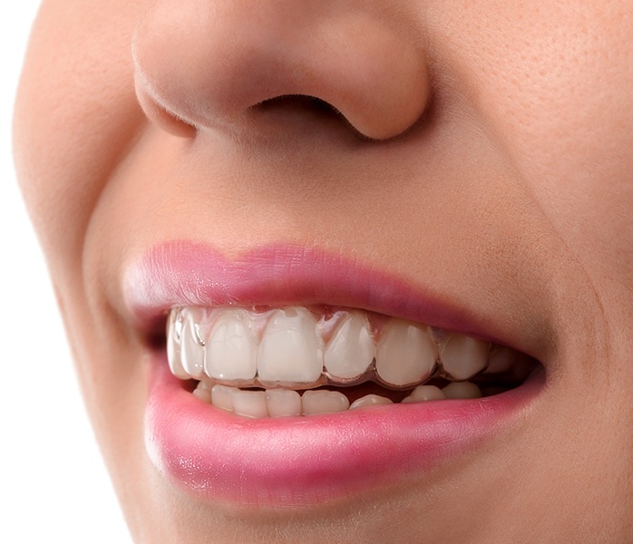 Closeup of smile with Invisalign tray in place