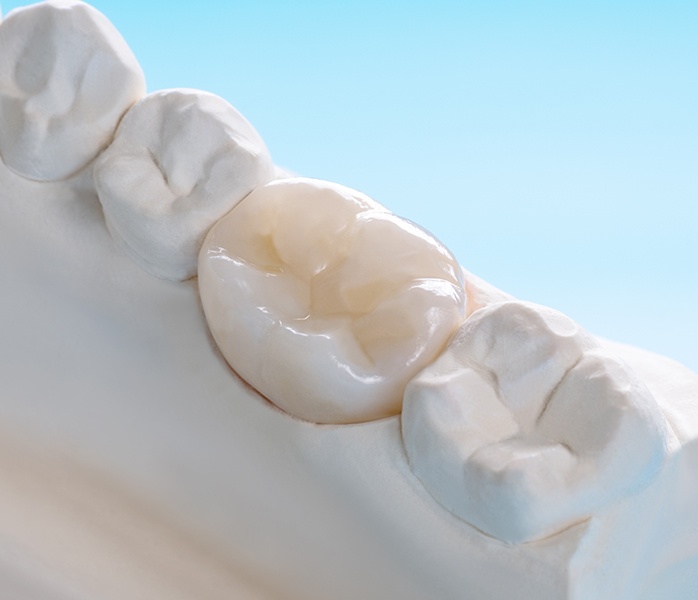 Model smile with dental crown restoration