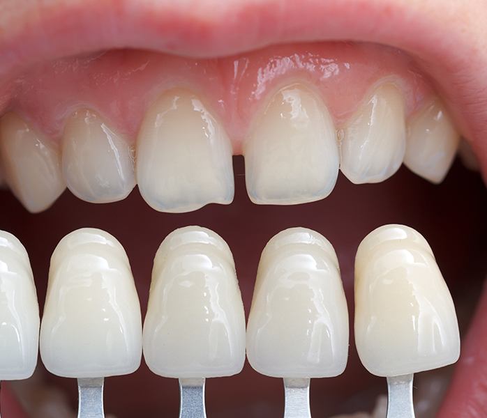 Closeup of smile before metal free dental restorations