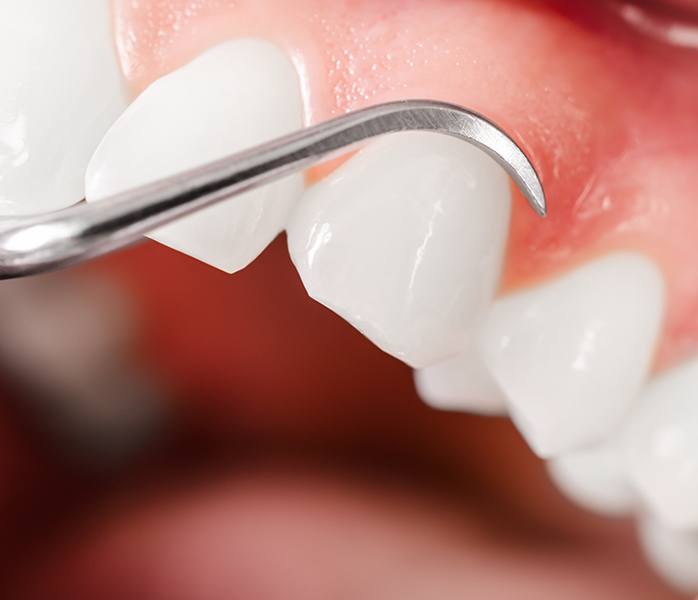 Patient receiving chao pinhole surgical technique treatment