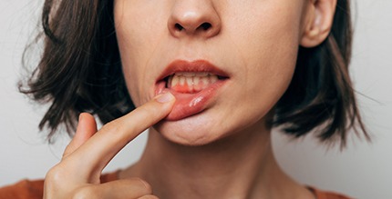 Woman with gum irritation