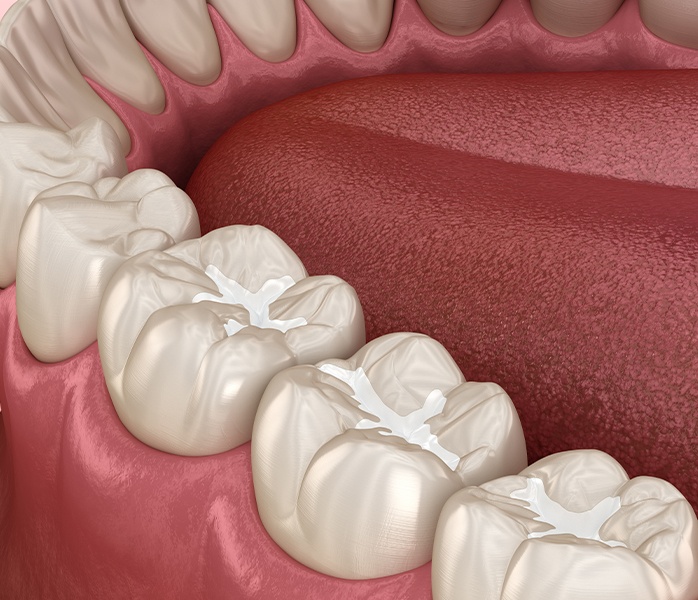 Animated smile with three tooth colored fillings