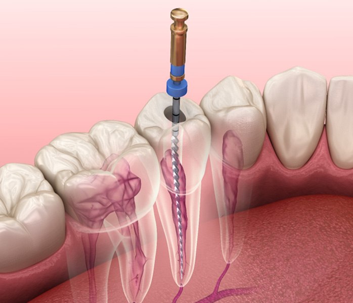 A 3D illustration of root canal therapy