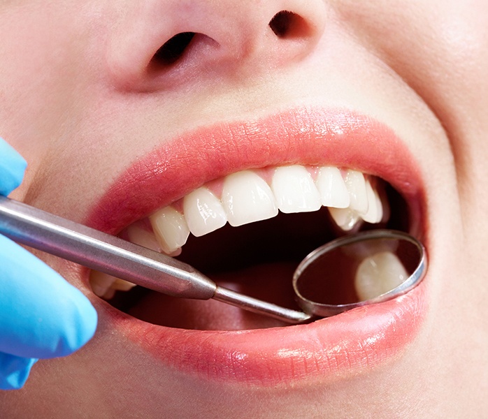 Dentist examining patient's smile after tooth colored fillings