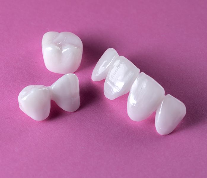 Porcelain veneers compared with other tooth colored dental restorations