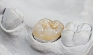 tooth colored dental crown in mold