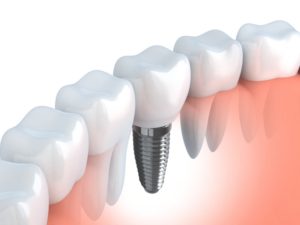 dental implant illustration