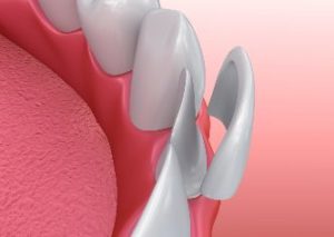 Model of a veneer being adhered to a front tooth