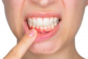 woman showing red spot on gums