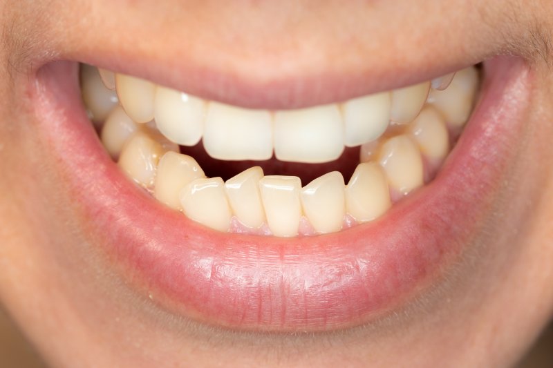 A man suffering from teeth shifting