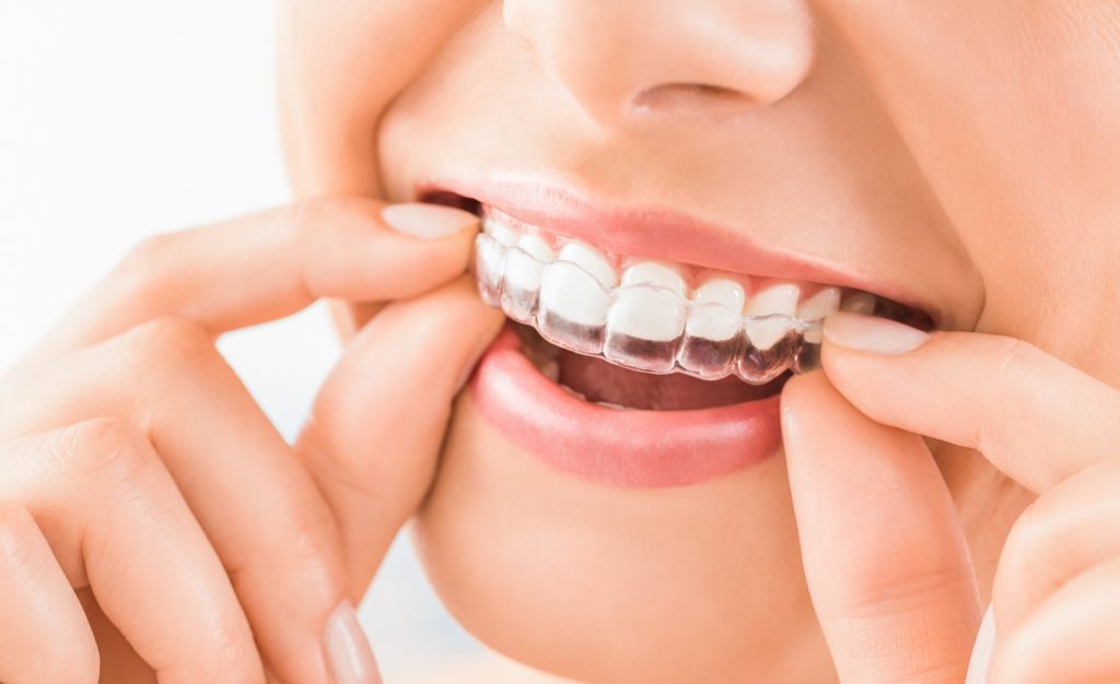 Closeup of woman smiling while placing clear aligner on top teeth