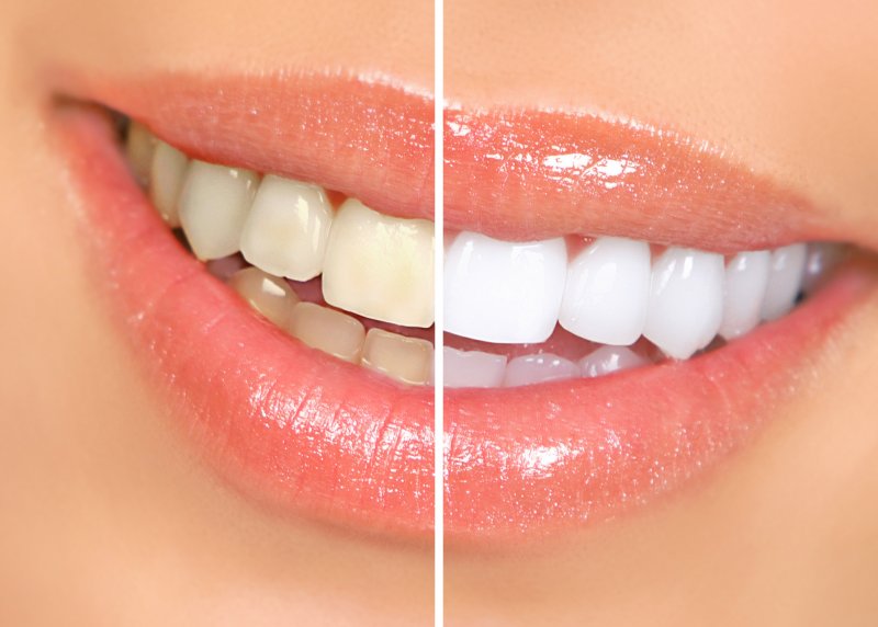 Before and after cosmetic dentistry