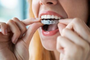 Woman putting on Invisalign clear aligner.