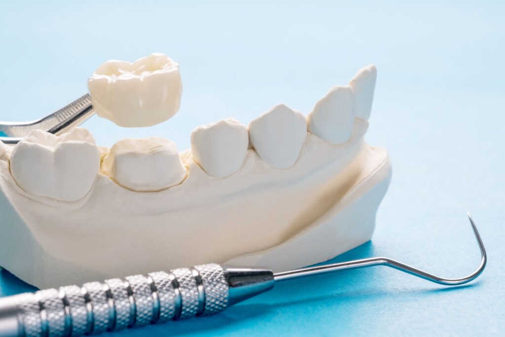 Dental crown being placed on model tooth