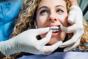 dentist inserting Invisalign aligner into patients mouth
